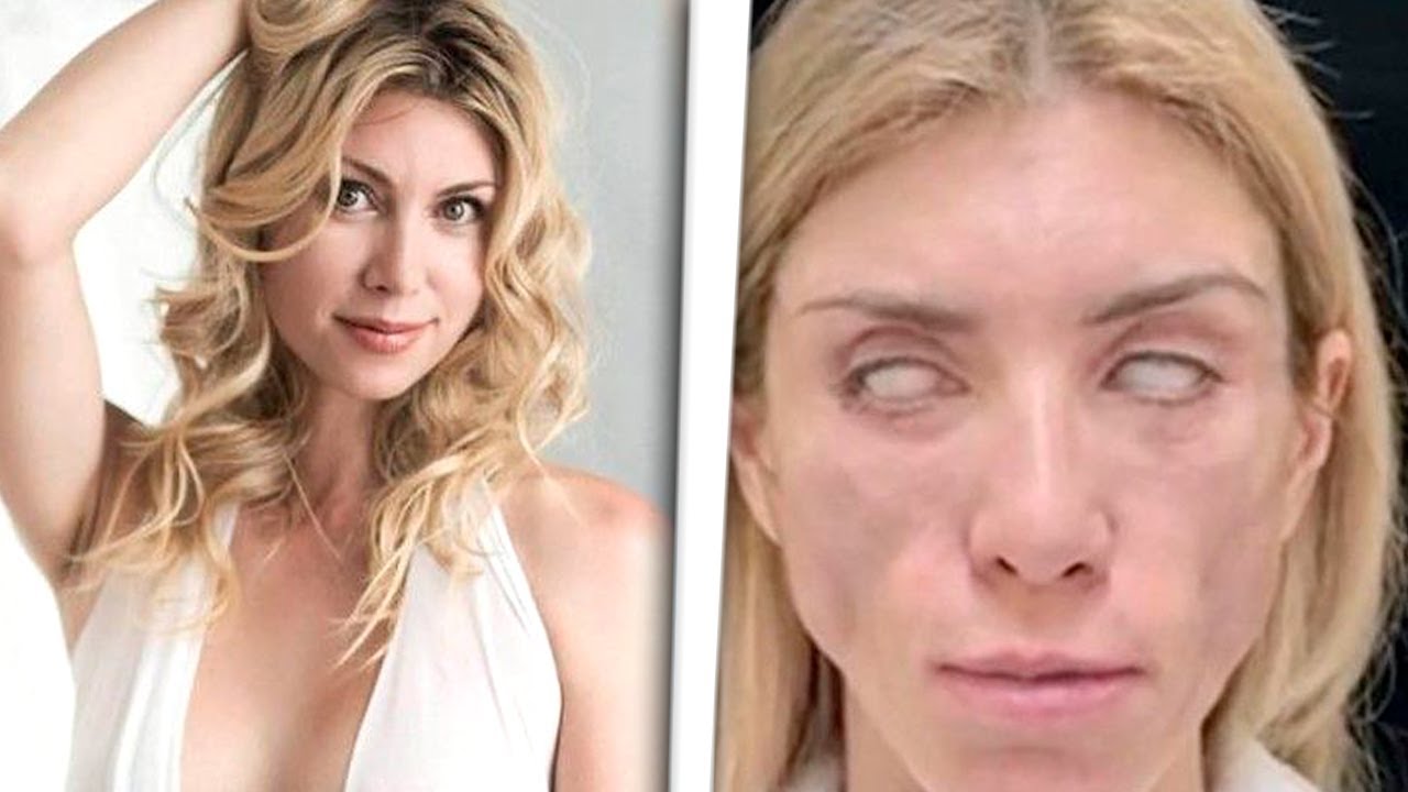 MODELO RUSA NO PUEDE SONREÍR NI CERRAR LOS OJOS LUEGO DE ERROR EN CIRUGÍA ESTÉTICA