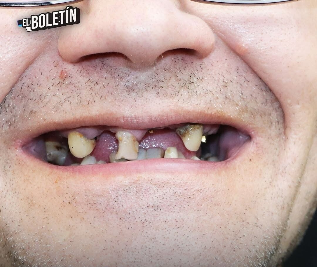 JAPÓN LOGRA AVANCE HISTÓRICO, CIENTÍFICOS LOGRARON REGENERAR DIENTES EN HUMANOS POR MEDIO A NOVEDOSO FÁRMACO.